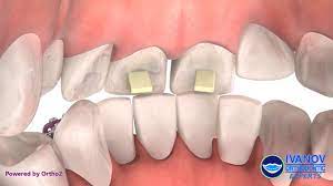 See full list on wikihow.com Orthodontic Dental Bite Turbos Bite Ramps Bite Block Braces