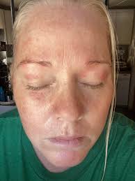 Rowe Casa products for contact dermatitis relief