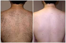 Exfoliate the area before shaving to allow the hair that was destroyed by the laser to fall out. The Fotona Coollase For Men Centro Medico Estetico Dr Cardenas