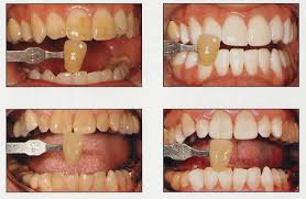 Snow® was engineered to be the most advanced formula & whitening technology in the world. Deep Laser Teeth Bleaching In San Diego