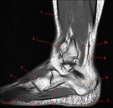 The machine uses radio waves and a magnetic field to generate images of the inside of the extremity in order to diagnose problems with the muscles, bones, joints, nerves, or blood vessels. Mri Of The Ankle Detailed Anatomy W Radiology