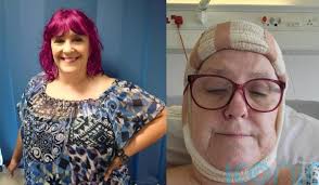 School finance officer fears she looks like “a gargoyle” or “Frankenstein's  monster” as virulent skin cancer leaves bald “craters”