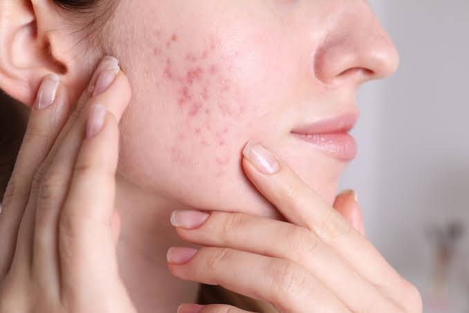 Jenis-Jenis Jerawat dan Cara Mengatasinya dengan Tepat - Klinik Bamed