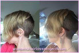 Hair loss (alopecia) can affect just your scalp or your entire body, and it can be temporary or baldness typically refers to excessive hair loss from your scalp. Prp Is It My Miracle Women S Hair Loss Project