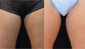 Thigh coolsculpting is designed to address the stubborn fat pockets on the inner or outer thighs. Coolsculpting What Will It Take To Look Like This Part 2