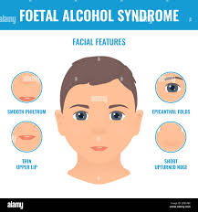 Foetal alcohol syndrome hi-res stock photography and images - Alamy