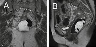 Posted 2 years ago, 5 users are following. Imaging Of Colorectal Cancer The Clue To Individualized Treatment