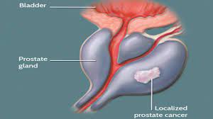 These symptoms include burning or pain the symptoms of prostate cancer often differ from patient to patient. Men S Health Issues Related To Prostate Lifestyle General Kerala Kaumudi Online