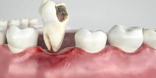 Image result for Tooth Extraction