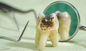 Chipped tooth is a relatively common dental problem in both adults and children. Signs Of A Dead Non Vital Tooth St Lawrence Dentistry