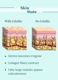Secondly, collagen strengthens the connective tissue of the skin. 20 Remedies For Cellulite I The Most Complete Guide