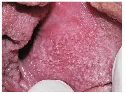 I'M A 17-Year-Old Girl And Have Flesh Colored Bumps On My Vagina Lips.  There Is No Pain, Burning, Or Itching. They Are Very Small And Clusters On  Both Sides. What Should I