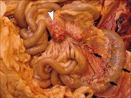 Peritonitis is an inflammation of the peritoneum, the tissue that lines the inner wall of the abdomen and covers and supports most of your abdominal organs. Peritonite Granulomatosa Associada Ao Frscv As Lesoes Sao Multifocaise Download Scientific Diagram