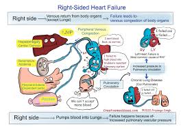 Image result for Right Heart Failure