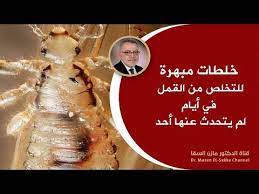 هل تعلم ماأسباب ظهور قمل شعر الرأس وأسهل طرق التخلص من القمل علاج القمل نهائيا بطرق طبيعية youtube movie posters movies