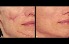 Check spelling or type a new query. 10 Things To Know Before Having Laser Treatment For Your Scar