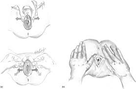 I altered the dolls myself as well. Hymen An Overview Sciencedirect Topics
