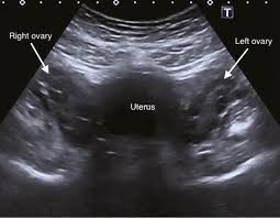Maybe you would like to learn more about one of these? Ultrasound Of Pelvic Anatomy Scanning Techniques And Normal Findings Chapter 4 Ultrasound In Reproductive Healthcare Practice