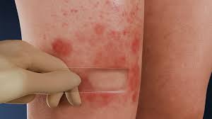 Image result for Diascopy