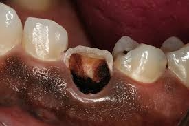 Maybe you would like to learn more about one of these? Restoring Severely Compromised Teeth With A Core Build Up Volume 6 Issue 10 Inside Dentistry