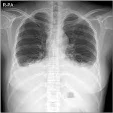 Imaging of pleural plaques, thickening, tumors. Chest X Ray Shows Bilateral Pleural Effusion Fourth Postoperative Day Download Scientific Diagram
