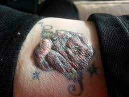 I don't have any tattoos, but i know plenty of people who do. Cancer From A Tattoo Imgur