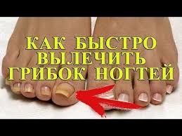 как вылечить грибок на ногах в домашних условиях видео Kak Lechit Gribok Nogtej V Domashnih Usloviyah Naturalnye Narodnye Metody Lecheniya Youtube Zdorove Zhenskoe Zdorove Lichnaya Gigiena