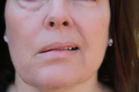 Bell's palsy can be a frightening experience, appearing suddenly with symptoms that cause many people to think they're having a stroke. Acupuncture For Bell S Palsy Tlc Acupuncture Brisbane