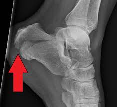 Image result for Calcaneus