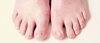 Dalam dunia medis, kondisi ini disebut dengan resistensi insulin. Waspada Kuku Kuning Bisa Jadi Tanda Diabetes