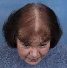 Hairstyles For Women With Hair Loss More Info Could Be Found At The Image Url Hairlosstreatment Hair Loss Remedies Stop Hair Loss Female Pattern Hair Loss