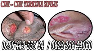 Semua wanita hamil akan diminta untuk menjalani tes darah guna memeriksa sifilis dan infeksi. Cara Penyembuhan Sipilis Raja Singa Obat Herbal Manjur