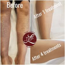 The original type of electrolysis is called galvanic. Queens Laser And Electrolysis Hair Removal 30 Photos 77 Reviews Laser Hair Removal 87 08 Justice Ave Elmhurst Ny United States Phone Number Yelp