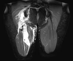 The setup, the initial pull or drive, and the lockout. Offene Refixation Bei Proximalen Hamstring Verletzungen Springerlink