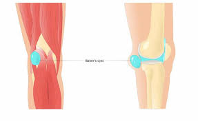 Wenn du diese beiden punkte drückst, kannst du deine knieschmerzen einfach. Kniekehlen Schmerzen Symptome Ursachen Und Ubungen Liebscher Bracht