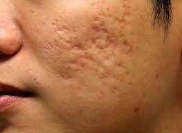 This can cause red, inflamed pimples (called papules) and red a person's acne needs to be under control before scars can be treated. Acne Scar Removal Treatments And The Options Available