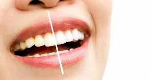 20 cara memutihkan gigi secara alami yang mudah dan cepat. 7 Cara Mudah Mengatasi Gigi Kuning Pada Remaja Di Rumah Popmama Com