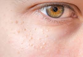 What causes bumps on arms? Does Your Skin Have Tiny White Bumps Leave Them Alone Health Essentials From Cleveland Clinic