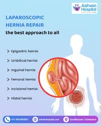 Image result for Hernia Reduction