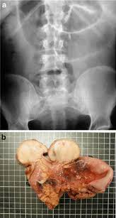 Image result for Adult Intussusception