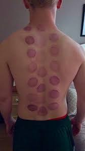 Don't be afraid of cupping massage bruising Cupping Bruises