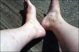 How to get rid of fleas on humans skin. Fleas Mu Extension