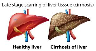 Cirrhosis of Liver - Gastro Care