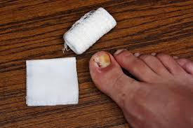 Curled Toe Nails All About Pincer Nails And Ingrown Toenails all about pincer nails and ingrown toenails