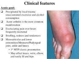 Gouty Arthritis
