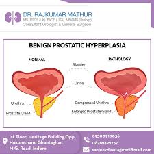 Benign Prostatic Hyperplasia Bph Benign Prostatic Hyperplasia Enlarged Prostate Urologists