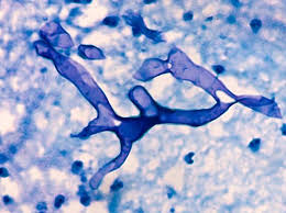In an advisory, it also said the fungal infection mainly affects people who are on medication. Kwjswwtyvkimcm
