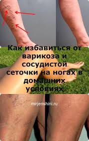 чем лечить варикозное расширение вен на ногах в домашних условиях Kak Izbavitsya Ot Varikoza I Sosudistoj Setochki Na Nogah V Domashnih Usloviyah V 2020 G Varikoz Zdorove Legkaya Eda