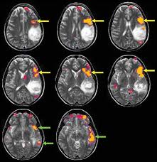 History And Evolution Of Brain Tumor Imaging Insights Through Radiology Radiology