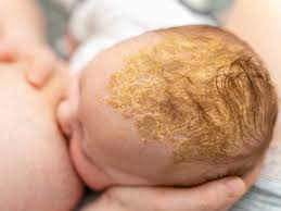 Image result for Cradle Cap
